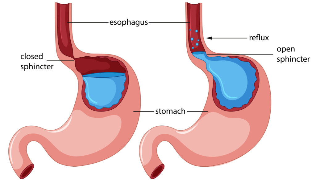 GERD Treatment in HSR Layout