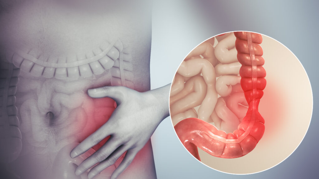 IBS Treatment in HSR Layout