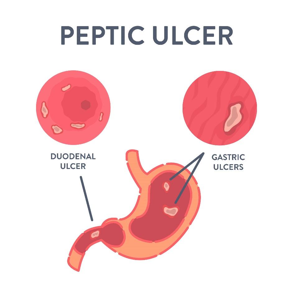 Peptic Ulcer Disease Treatment in HSR Layout