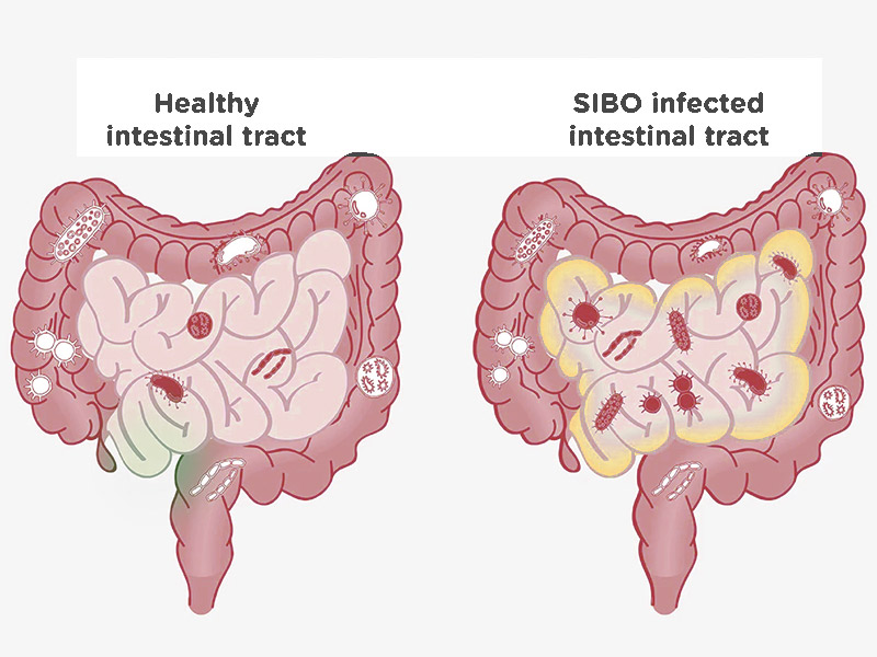 SIBO Treatment in HSR Layout