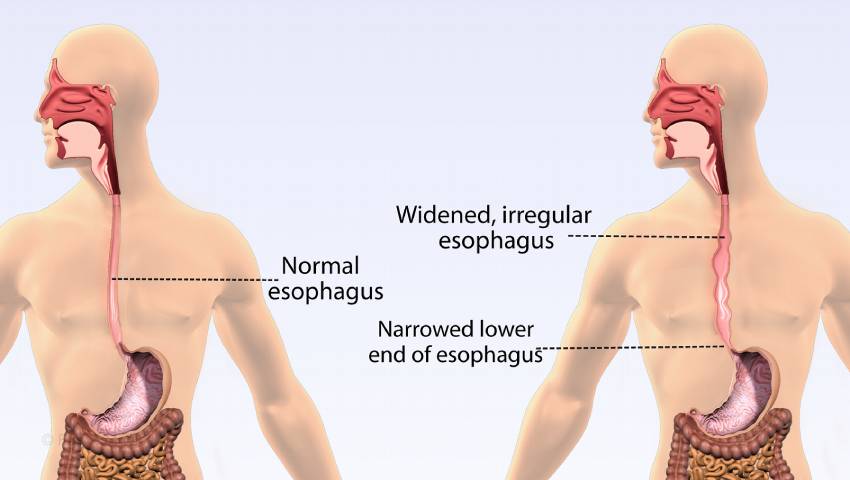 Achalasia Cardia in HSR Layout