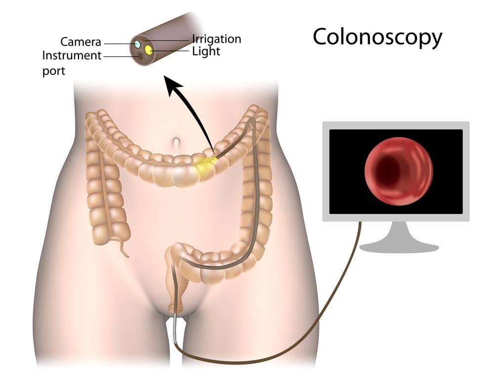 Colonoscopy in HSR Layout