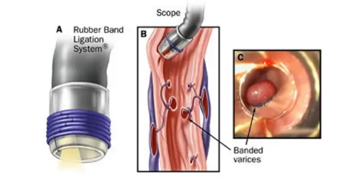Endoscopic Variceal Ligation in HSR Layout