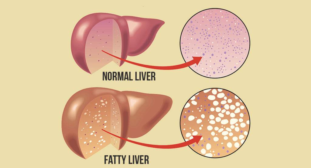 Fatty Liver Programs in HSR Layout