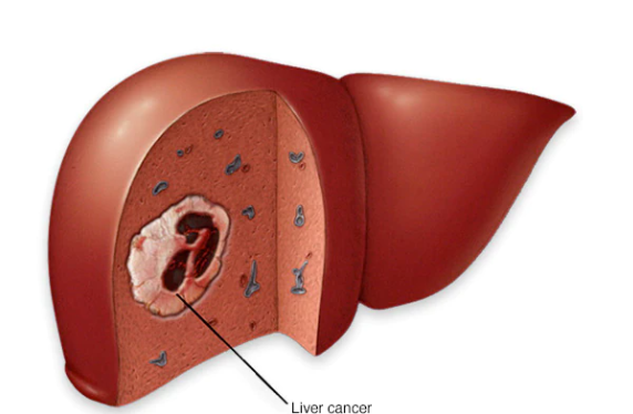Liver Cancer Treatment in HSR Layout