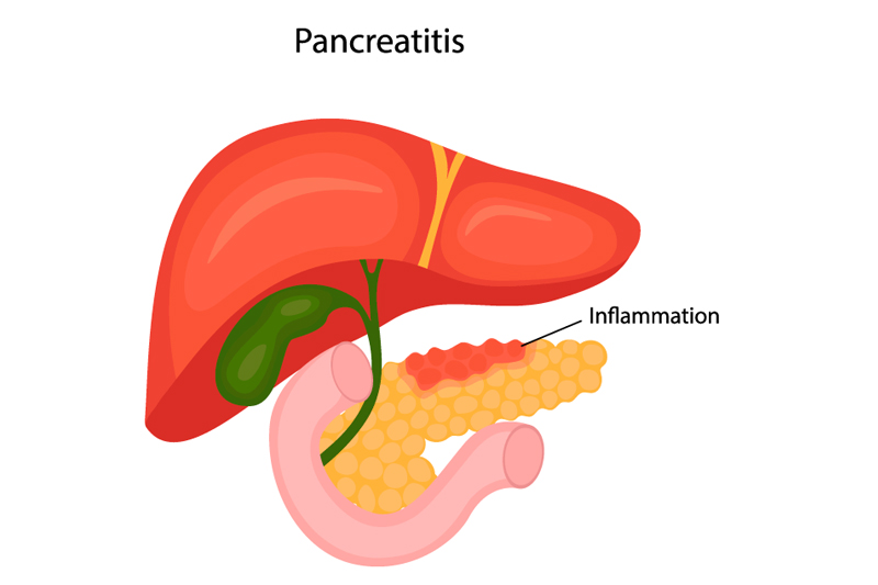 Pancreatic Diseases Treatment in HSR Layout