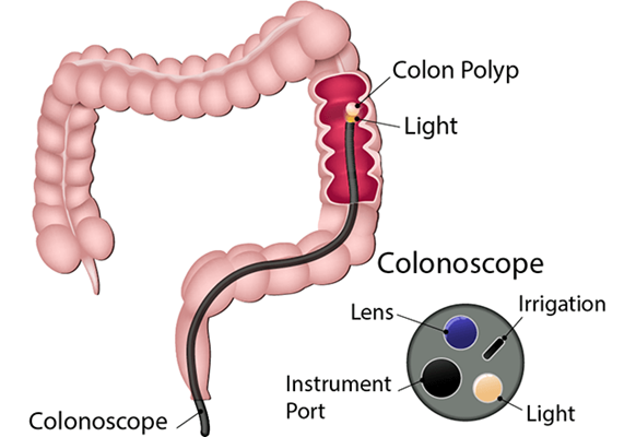 Sigmoidoscopy in HSR Layout