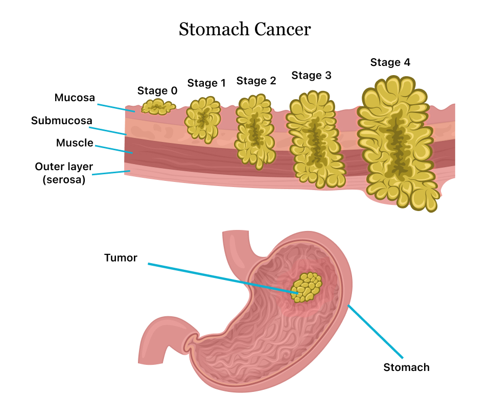 Stomach Cancer Treatment in HSR Layout