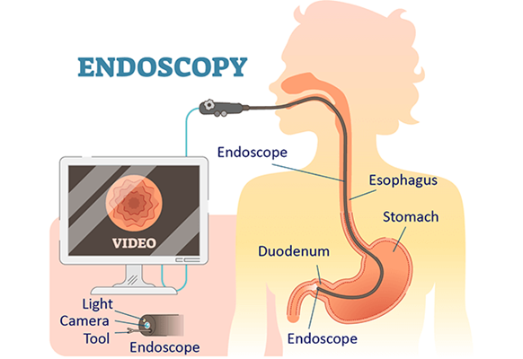 Upper GI Endoscopy in HSR Layout