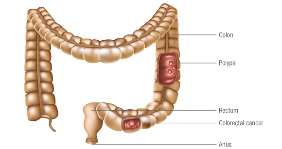 Colon Cancer Treatment in HSR Layout