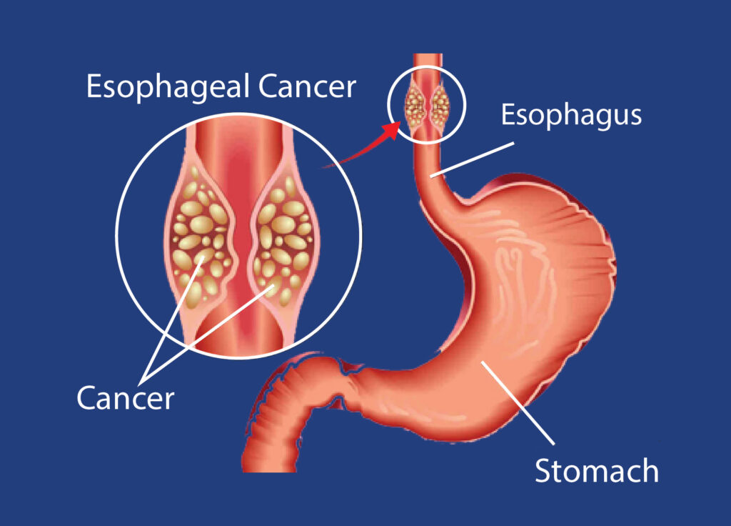 Esophageal Cancer Treatment in HSR Layout