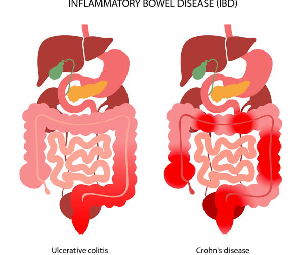 IBD Treatment in HSR Layout