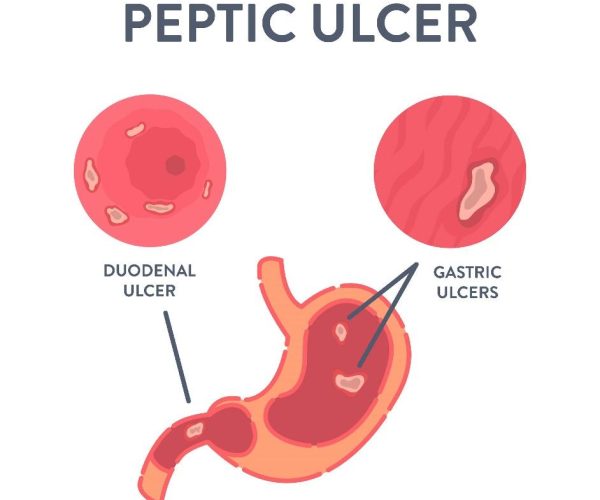Peptic Ulcer Disease Treatment in HSR Layout
